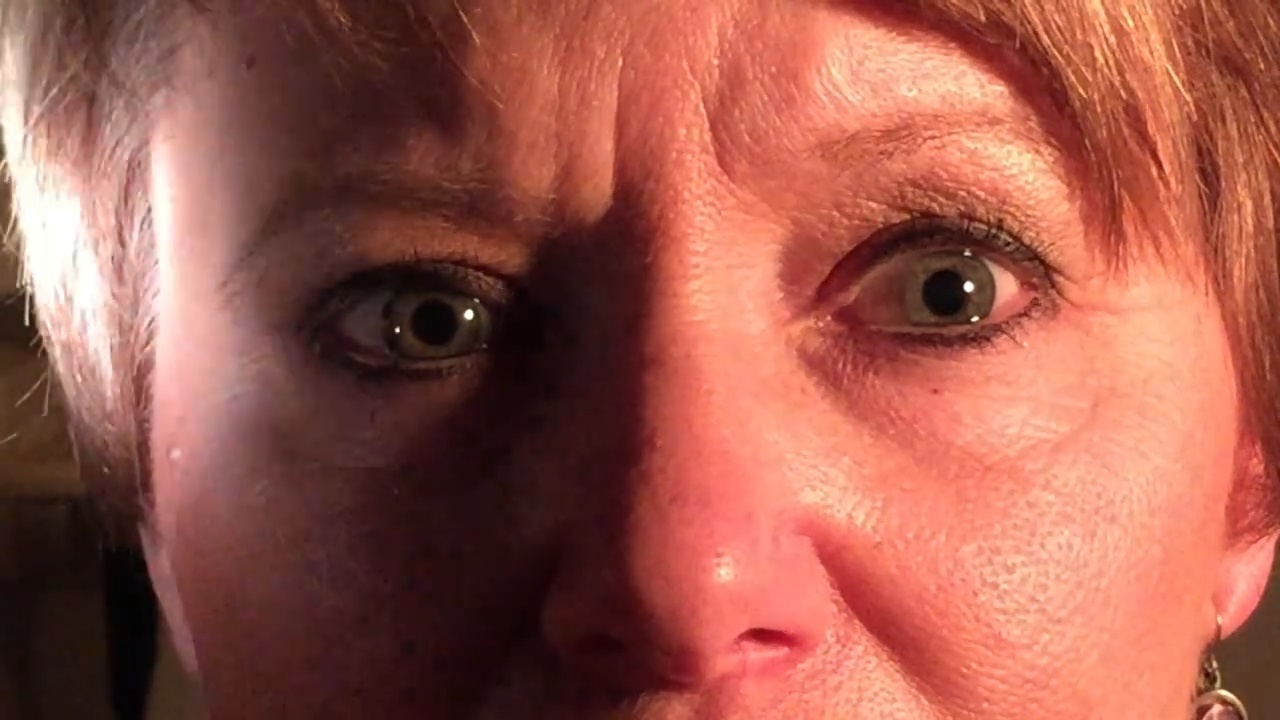 Marcus Gunn Pupil also called Relative Afferent Pupillary Defect  RAPD