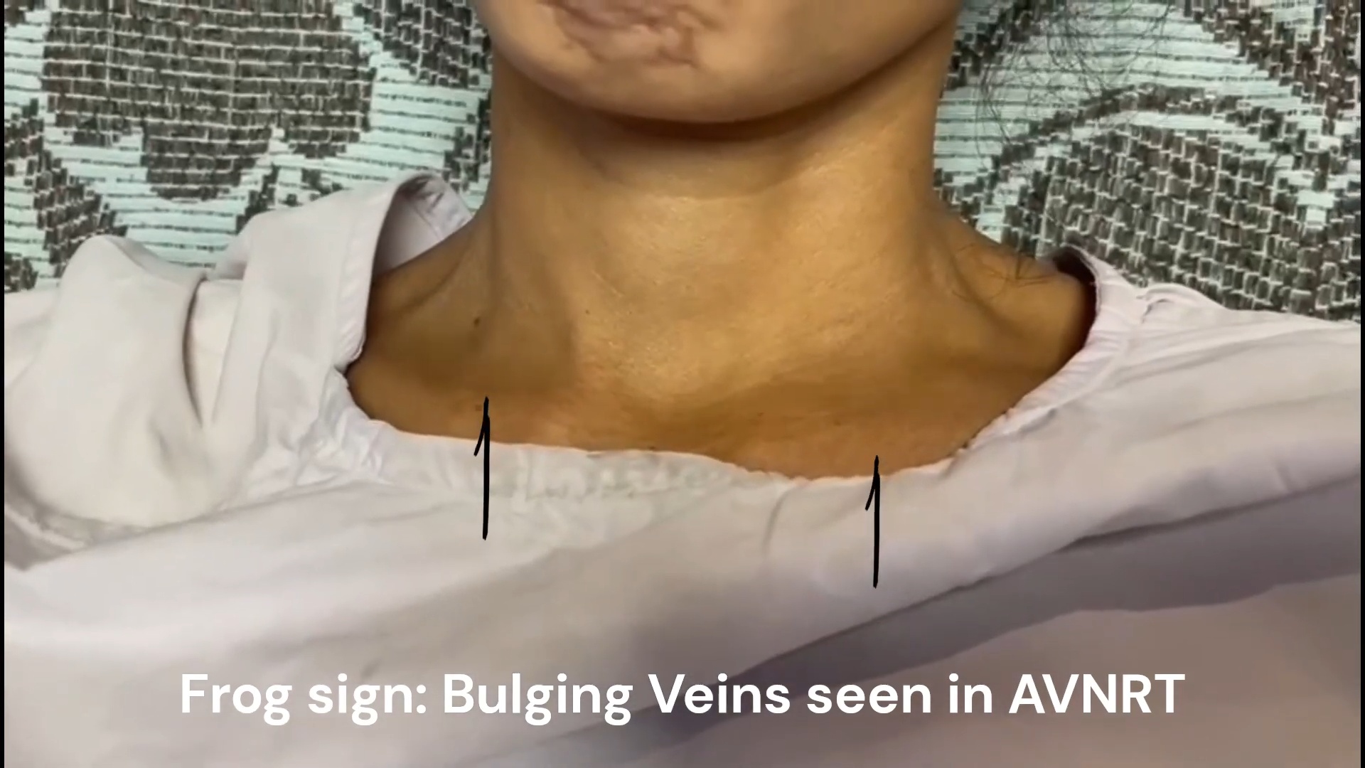 Frog Sign Cardiology